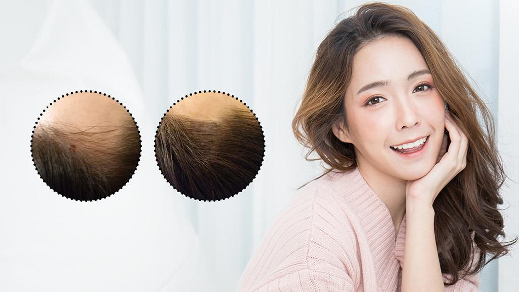女生一定要知！2小時解決髮量少！必試美容界大熱「紋髮」
